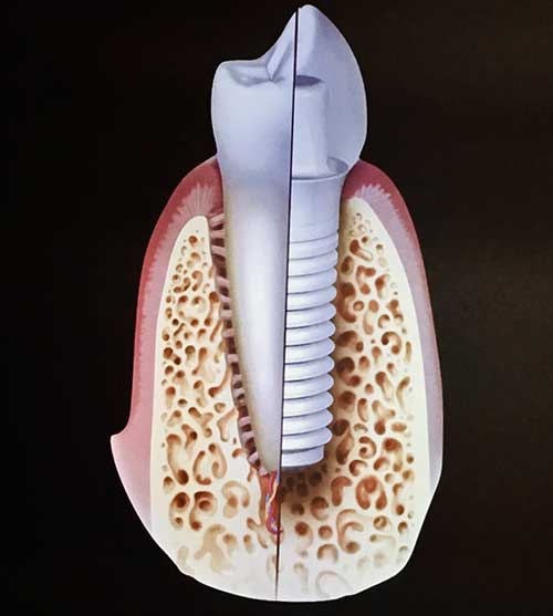 Kunstoff Zahnfüllung