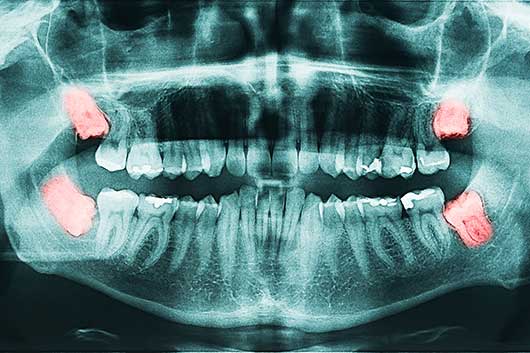 professionelle Zahnreinigung Zahnfleisch