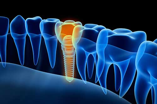 Parodontose Behandlung beim Zahnarzt