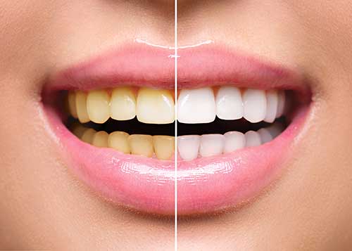 professionelle Zahnreinigung gelbe Zähne